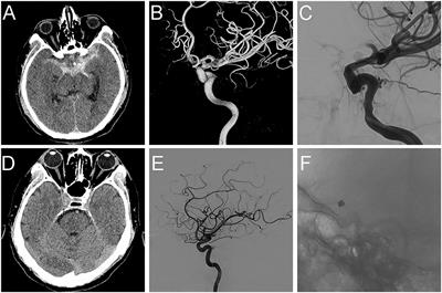 Treatment of Blood Blister Aneurysms of the Internal Carotid Artery With Pipeline-Assisted Coil Embolization: A Single-Center Experience